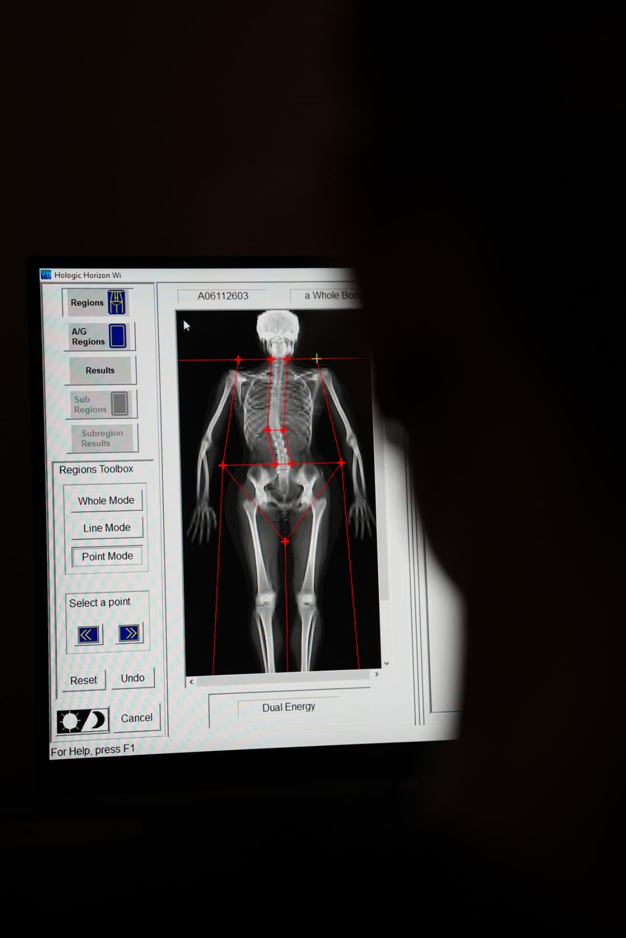 DEXA-mätning av bentäthet i ländrygg och höfter på klinikens skärm