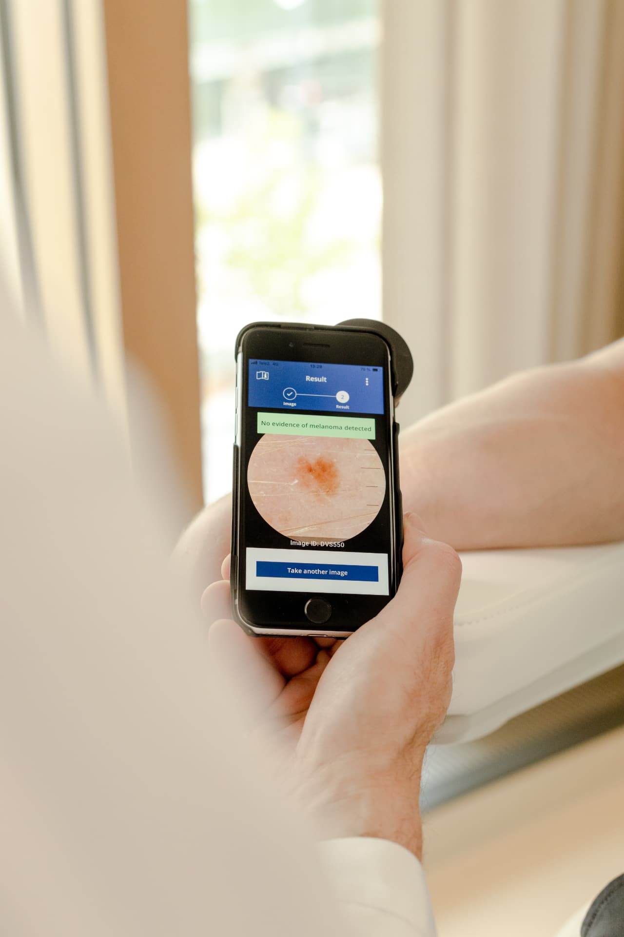 Dermalyser-appen visar resultat av en hudkontroll